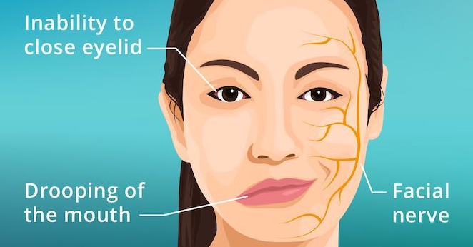 Bell’s palsy